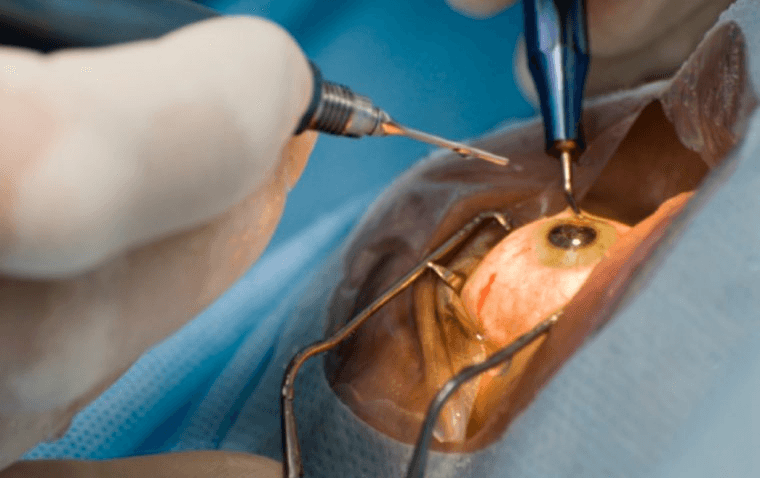 Modern Cataract Surgery Systems